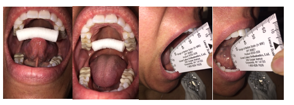 Myofunctional impairment shown with range of motion scales